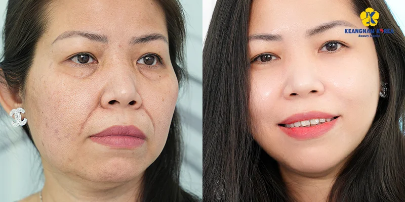 Comparison of 2 Melasma Treatment Methods at Keangnam Korea 7 Reborn Cell Extra+ – A next-generation all-in-one rejuvenation melasma treatment technology.