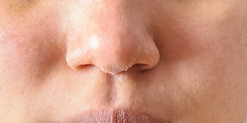 5 Reasons Why Melasma Keeps Coming Back After Treatment 3 Improper Post-Treatment Skin Care
