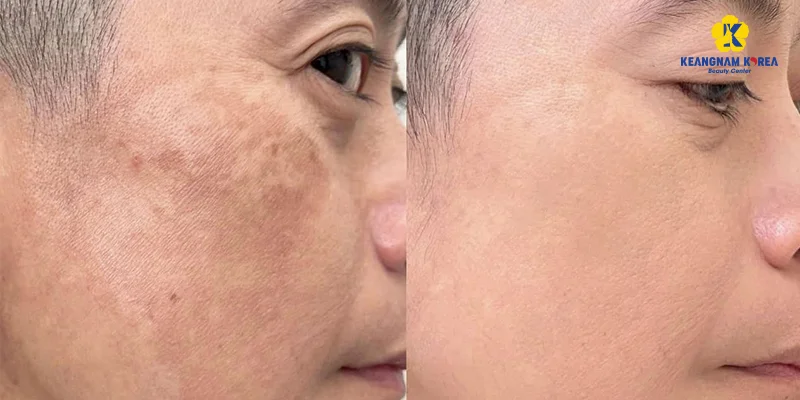 5 Reasons Why Melasma Keeps Coming Back After Treatment 6 Melasma Is Eliminated Deep From Within