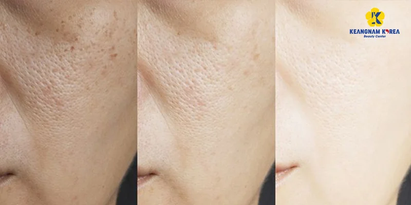 5 Reasons Why Melasma Keeps Coming Back After Treatment 5 Choose the Right Melasma Treatment Method