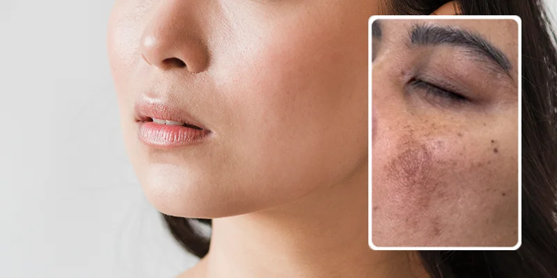 5 Reasons Why Melasma Keeps Coming Back After Treatment 1 5 Reasons Why Melasma Keeps Coming Back After Treatment