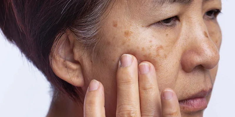 Is Hyperpigmentation Treatment at a Spa Safe and Reliable? 2 Consequences of Incorrect Hyperpigmentation Treatment