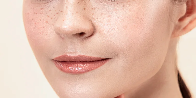 Is Hyperpigmentation Treatment at a Spa Safe and Reliable? 1 Is Hyperpigmentation Treatment at a Spa Safe and Reliable?