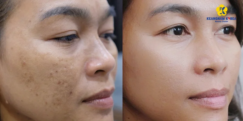 Skin Pigmentation Treatment Methods Based on 3 Severity Levels 6 Skin Pigmentation Treatment Methods