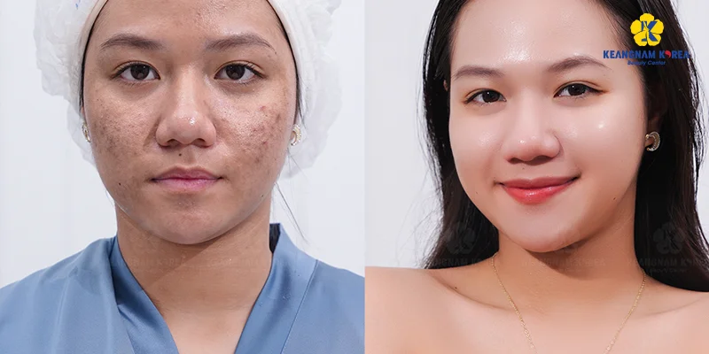 Best Treatment for Melasma: 5 Effective Ways to Remove Facial Pigmentation 5 Treating Melasma with EXO PCELL+ Technology