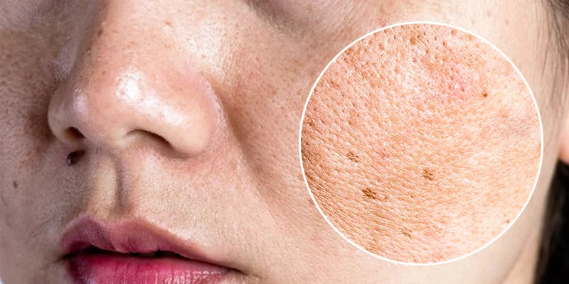Skin Pigmentation Treatment Methods Based on 3 Severity Levels 3 Mixed Pigmentation