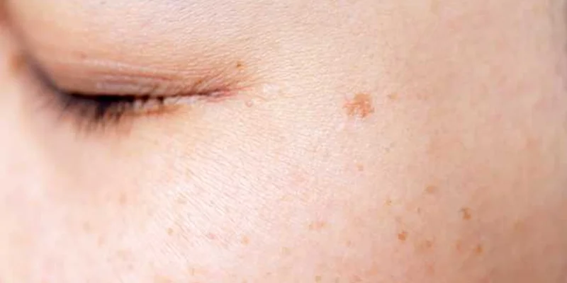 Skin Pigmentation Treatment Methods Based on 3 Severity Levels 2 Mild Surface Pigmentation