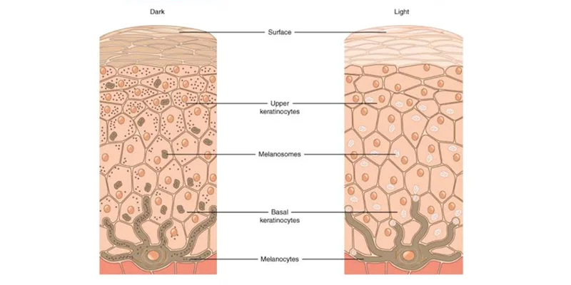 Skin Pigmentation Treatment Methods Based on 3 Severity Levels 4 Deep Dermal Pigmentation