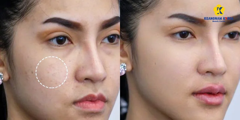 Skin Pigmentation Treatment Methods Based on 3 Severity Levels 7 Customers removing pigmentation with EXO PCELL+