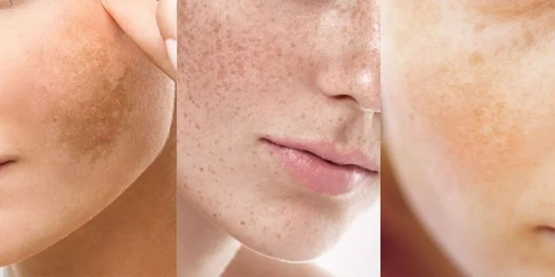 Skin Pigmentation Treatment Methods Based on 3 Severity Levels 1 Skin Pigmentation Treatment Methods Based on 3 Severity Levels