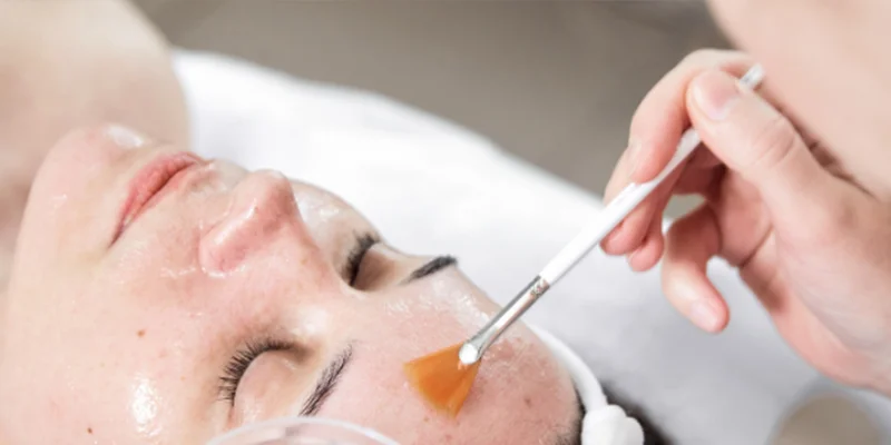 Should You Get a Chemical Peel for Melasma? What Are the Pros and Cons? 1 Should You Get a Chemical Peel for Melasma? What Are the Pros and Cons?