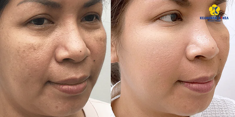 Is Hyperpigmentation Treatment at a Spa Safe and Reliable? 5 EXO PCELL+ Hyperpigmentation Removal Service
