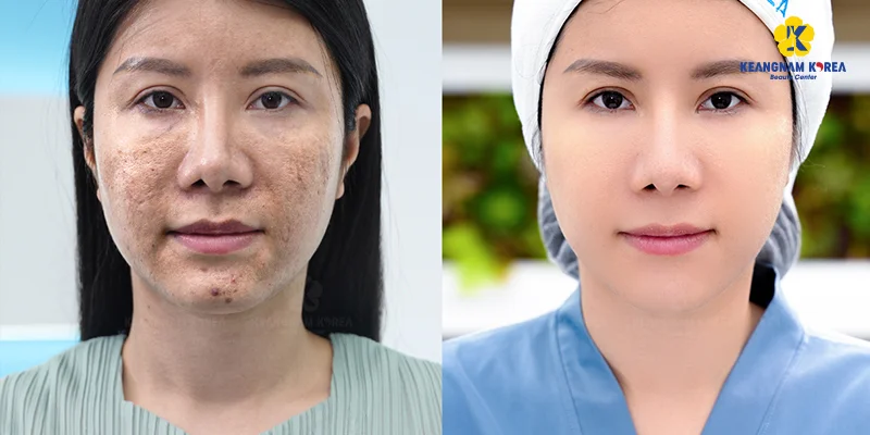 Should You Get a Chemical Peel for Melasma? What Are the Pros and Cons? 5 EXO PCELL+ Technology for Melasma Treatment