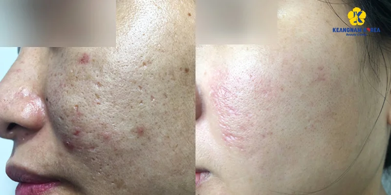 Is Microneedling for Melasma Recommended? What Are the Pros and Cons? 2 Is Microneedling for Melasma Recommended?