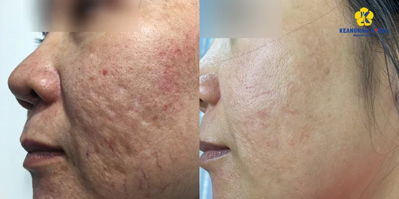 Is Microneedling for Melasma Recommended? What Are the Pros and Cons? 3 Microneedling for Melasma Before and After Images