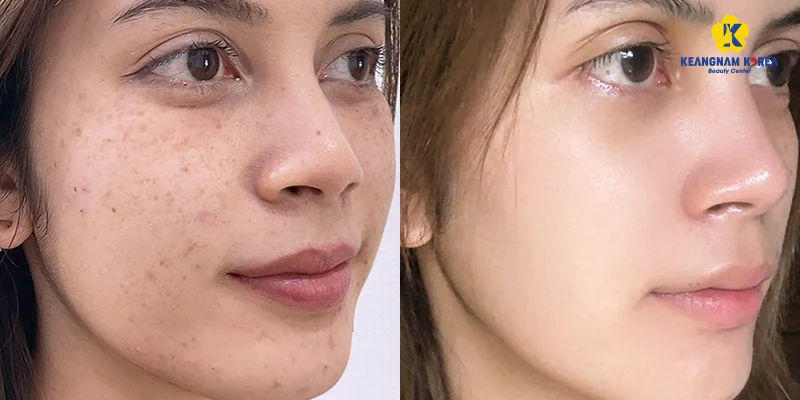Best Place for Dark Spot Treatment: Spa vs Dermatology Hospital vs Aesthetic Clinic 5 Why Choose Dark Spot Treatment at Keangnam Korea?