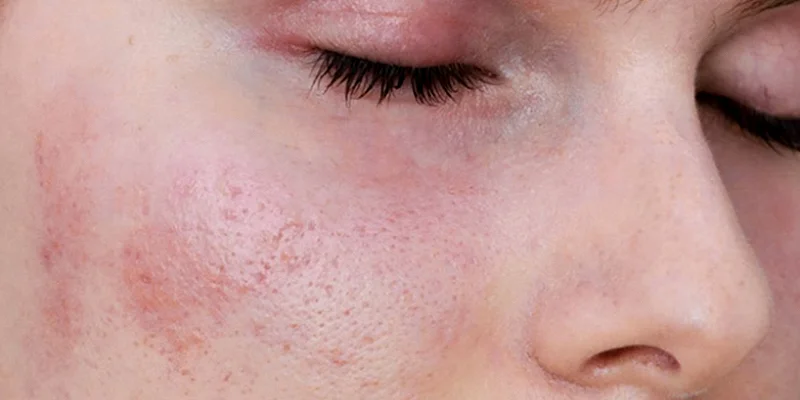 Should You Get a Chemical Peel for Melasma? What Are the Pros and Cons? 3 Advantages and Disadvantages of Chemical Peel for Melasma