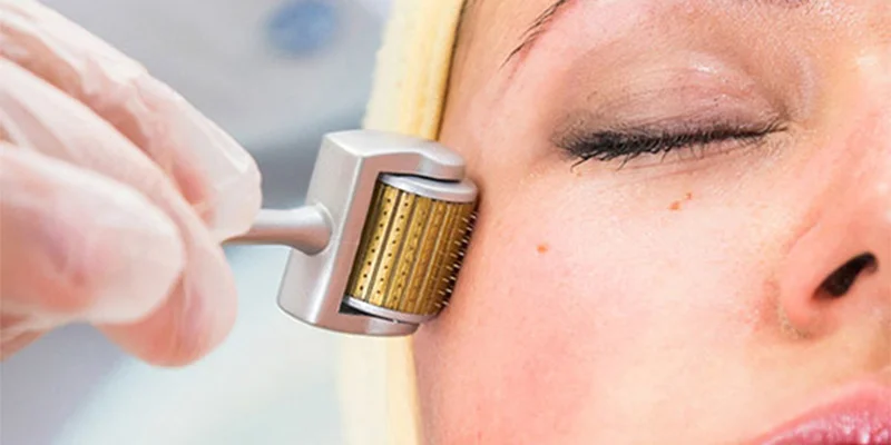 Best Treatment for Melasma: 5 Effective Ways to Remove Facial Pigmentation 2 Microneedling Treatment for Facial Melasma