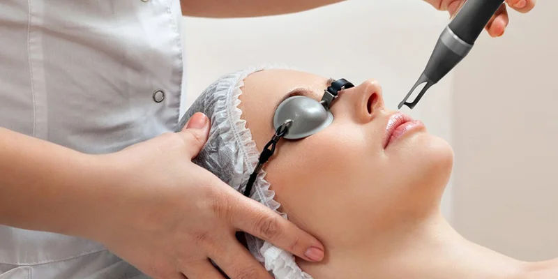 Best Treatment for Melasma: 5 Effective Ways to Remove Facial Pigmentation 1 Laser Treatment for Cheek Melasma