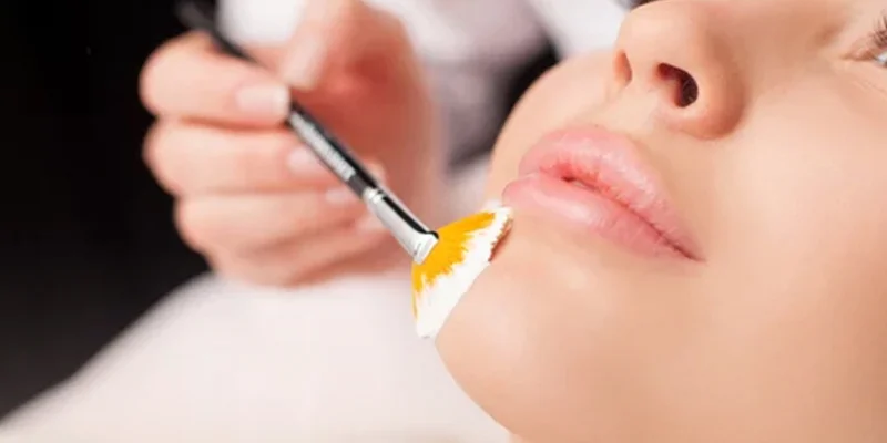 Best Treatment for Melasma: 5 Effective Ways to Remove Facial Pigmentation 3 Chemical Peel Treatment for Facial Melasma