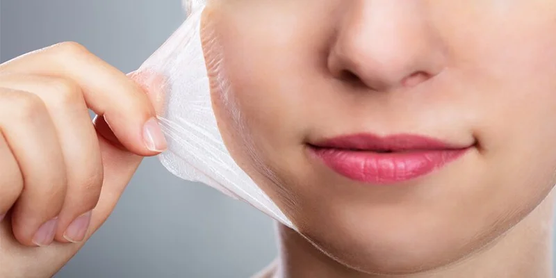 Should You Get a Chemical Peel for Melasma? What Are the Pros and Cons? 2 Is Chemical Peel for Melasma Effective?