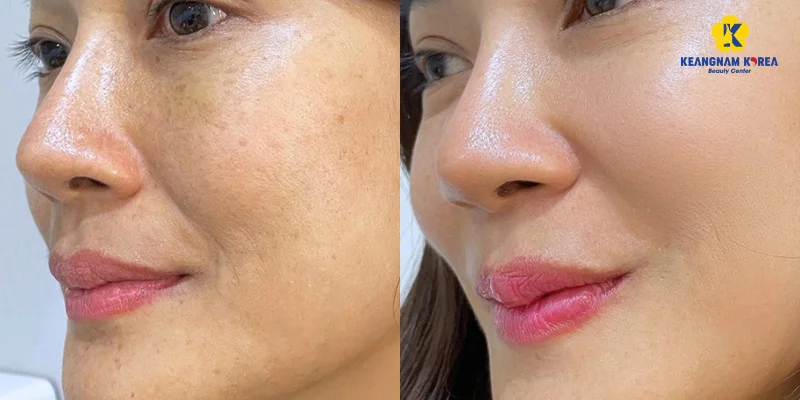 Is Microneedling for Melasma Recommended? What Are the Pros and Cons? 5 Melasma Treatment Methods