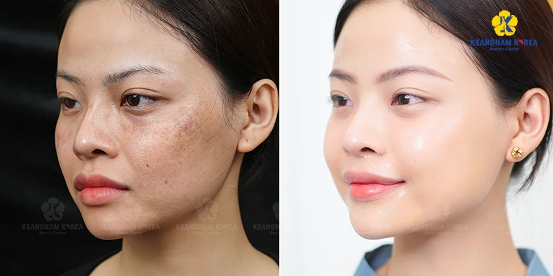 Should You Get a Chemical Peel for Melasma? What Are the Pros and Cons? 6 Technology for Melasma Treatment
