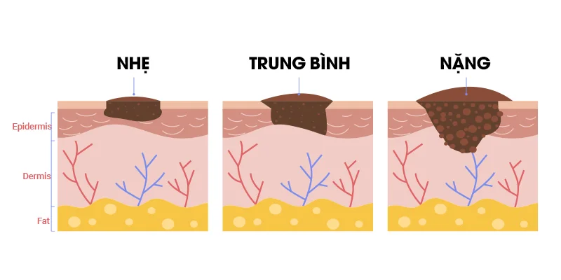 Melasma on Cheeks: 8 Effective Treatments from Mild to Severe 2 3 Stages of Melasma on Cheeks: From Mild to Severe