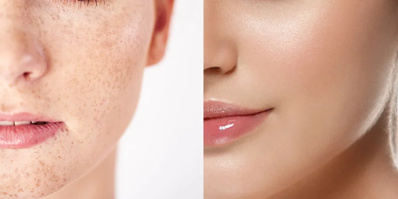 7 Effective and Gentle Freckle Treatment Methods for Long-Lasting Freckles 1 7 Effective and Gentle Freckle Treatment Methods