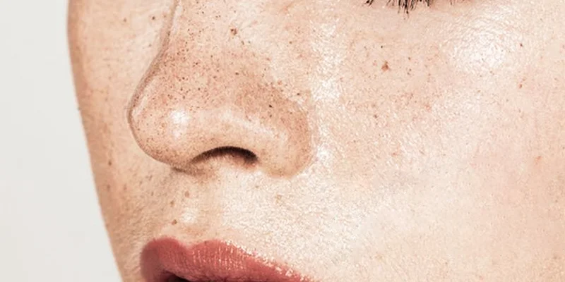 Melasma on Cheeks: 8 Effective Treatments from Mild to Severe 1 8 Effective Ways to Treat Melasma on Cheeks: From Mild to Severe