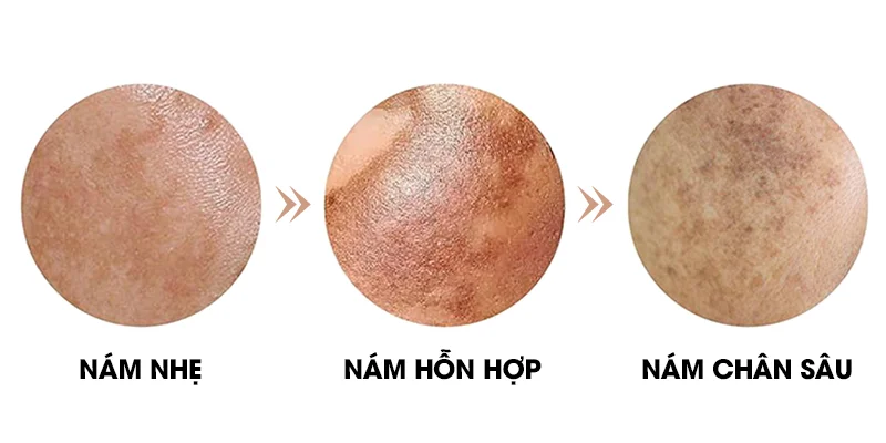 Mild Melasma: Causes, Symptoms & Best Treatment for Early Melasma 2 3 Common Types of Melasma Found on the Cheeks