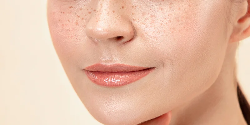 Mild Melasma: Causes, Symptoms & Best Treatment for Early Melasma 1 How to Recognize Mild Melasma