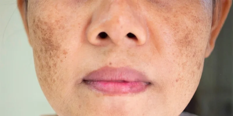 Epidermal Melasma: 6 Common Causes and 5 Effective Treatments 1 What Is Epidermal Melasma