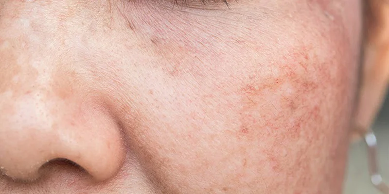 Is Meso for Melasma Effective? Benefits, Risks & Results 2 Who Should Choose Meso for Melasma?