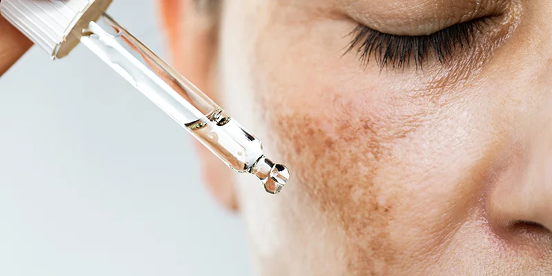 What Is Deep Melasma? Can It Be Treated? 4 Most Popular Deep Melasma Treatment Methods 2 How to Treat Deep Melasma on the Cheekbones