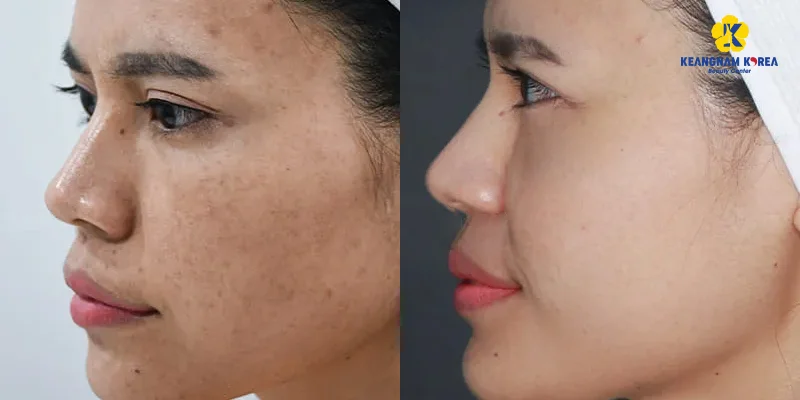 What Is Deep Melasma? Can It Be Treated? 4 Most Popular Deep Melasma Treatment Methods 5 Deep Melasma Treatment with Keangnam Korea’s Advanced EXO PCELL+ Technology