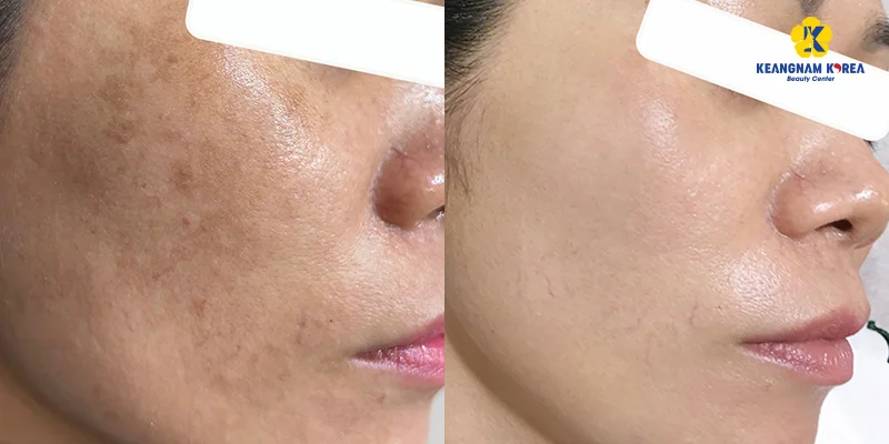 Epidermal Melasma: 6 Common Causes and 5 Effective Treatments 5 EXO PCELL+ Pigmentation Removal Technology