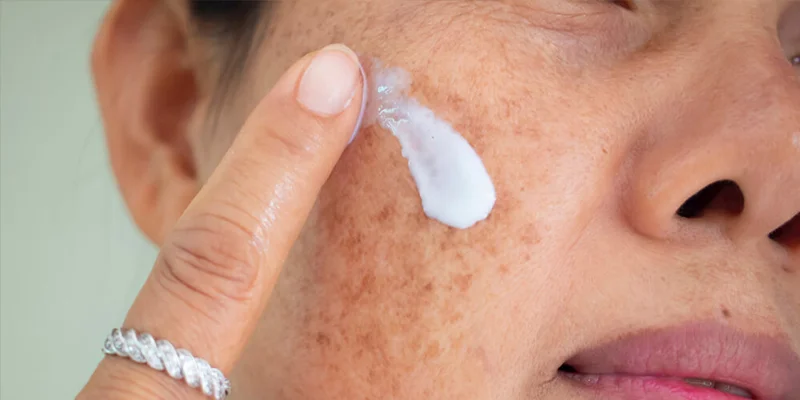 Epidermal Melasma: 6 Common Causes and 5 Effective Treatments 3 Effective Ways to Treat Epidermal Melasma at Home