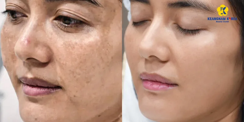 What Is Deep Melasma? Can It Be Treated? 4 Most Popular Deep Melasma Treatment Methods 6 EXO PCELL+ Pigmentation Removal Mechanism