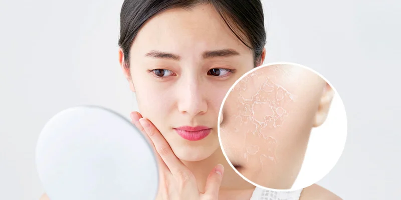 What Is Deep Melasma? Can It Be Treated? 4 Most Popular Deep Melasma Treatment Methods 4 Deep Melasma Removal with Laser Technology