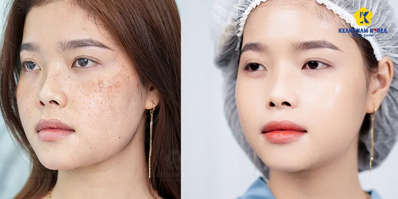 Mild Melasma: Causes, Symptoms & Best Treatment for Early Melasma 6 Experience EXO PCELL+ for Mild Melasma