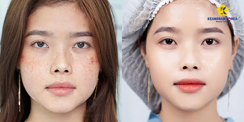 Melasma on Cheeks: 8 Effective Treatments from Mild to Severe 5 Before and After Melasma Treatment