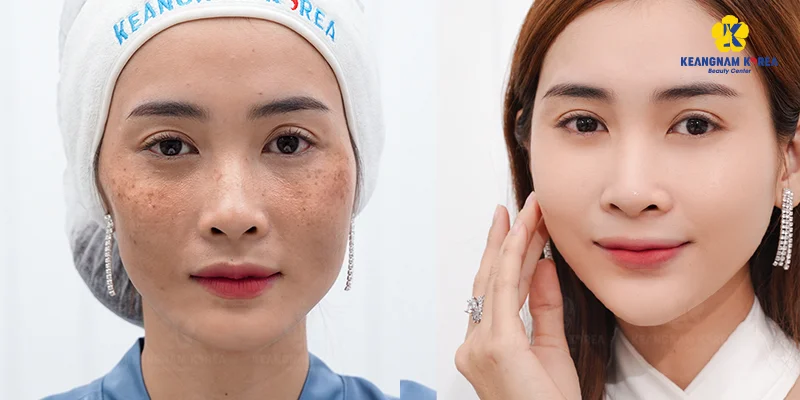 Is Meso for Melasma Effective? Benefits, Risks & Results 4 EXO PCELL+ High-Tech Melasma Treatment at Keangnam Korea
