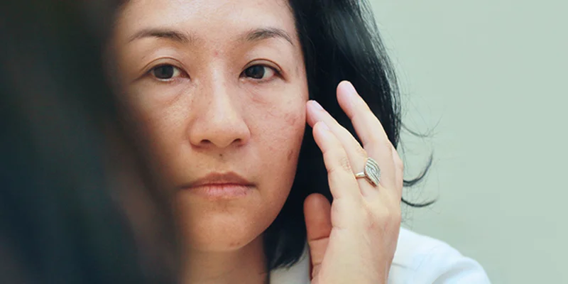 Epidermal Melasma: 6 Common Causes and 5 Effective Treatments 2 6 Causes of Epidermal Melasma