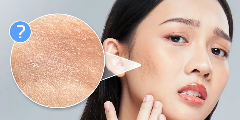 Hydrated Skin: 3 Ways to Restore Dry Skin Naturally 1 3 Ways to Achieve Hydrated Skin at Home for Dry Skin