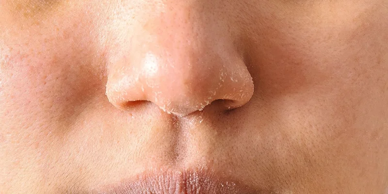 Hydrated Skin: 3 Ways to Restore Dry Skin Naturally 2 Causes and Signs of Dry Skin
