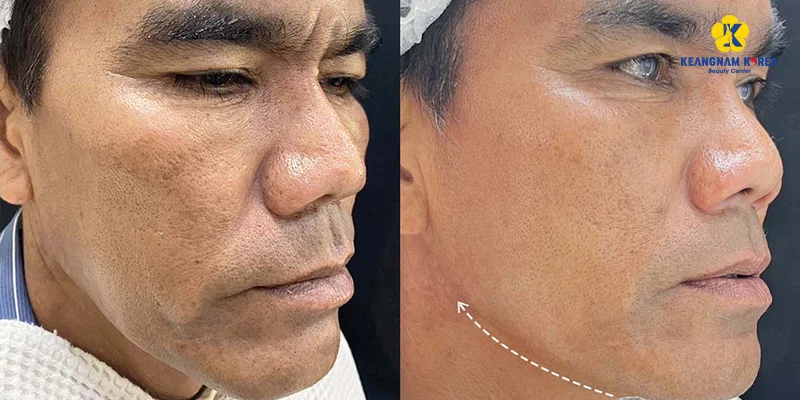 How to Get Glowing Skin for Men: 4 Expert-Recommended Methods 3 How to Tighten Facial Skin for Men with an Endoscopic Facelift