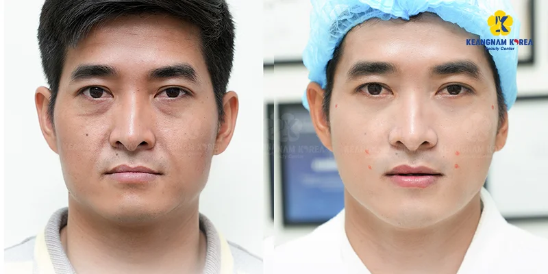 How to Get Glowing Skin for Men: 4 Expert-Recommended Methods 5 before and after men's facial rejuvenation