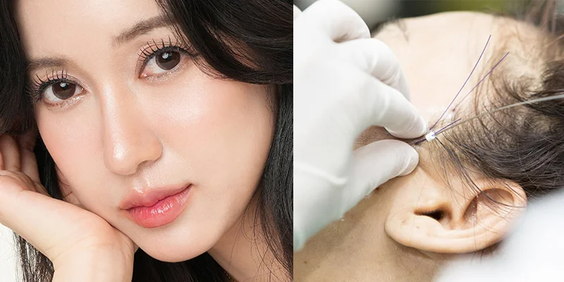 Non-Surgical Skin Tightening: 6 Best Treatments for Firmer, Younger-Looking Skin 2 Non-Surgical Skin Tightening with Collagen Threads