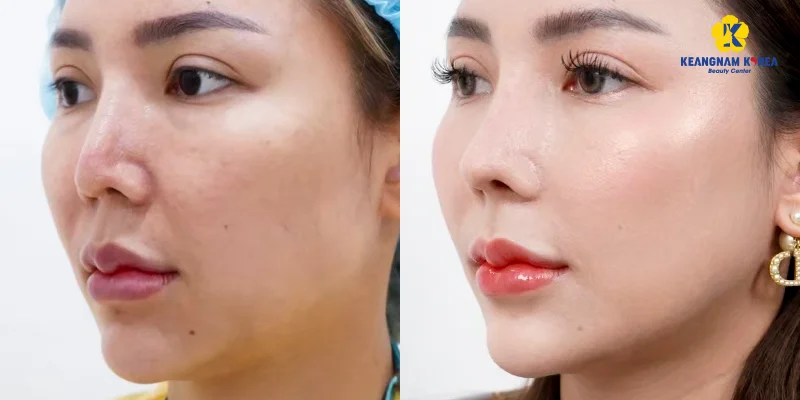 Non-Surgical Skin Tightening: 6 Best Treatments for Firmer, Younger-Looking Skin 4 Reborn Cell – Next-Generation Skin Rejuvenation Powered by EXOSOME Technology